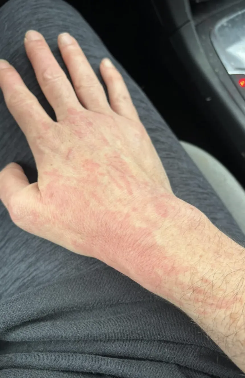 Blotchy red patches across the back of a hand and wrist