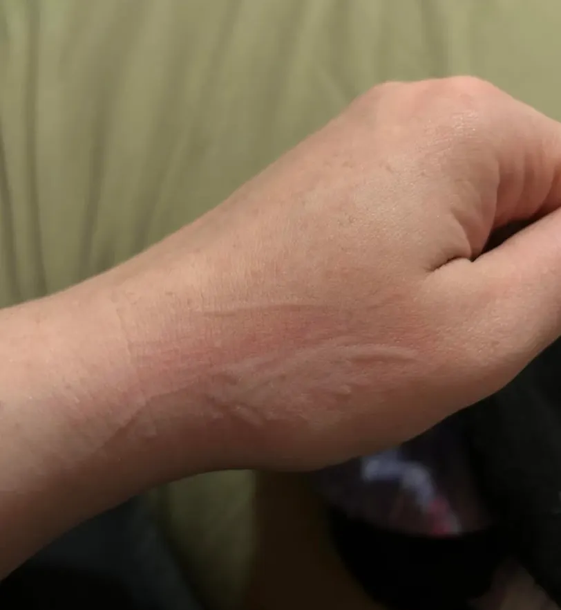 Back of a hand with faint marks as welts fade