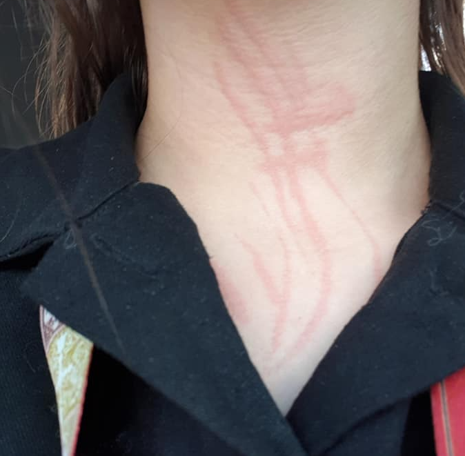 Vertical red streaks raised on the side of a neck after scratching