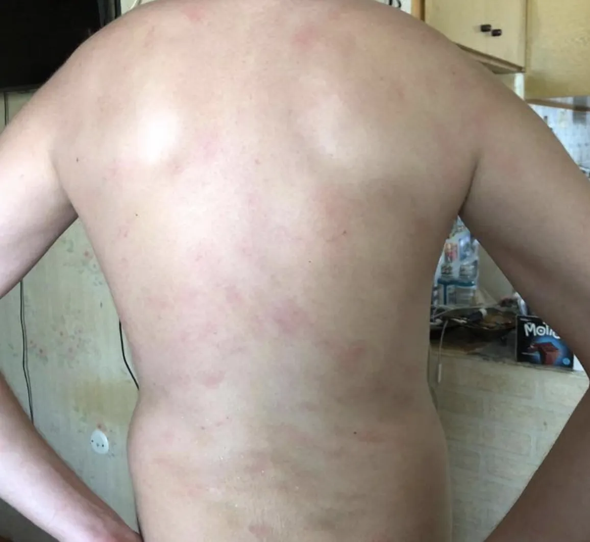 Widespread raised hives across a back