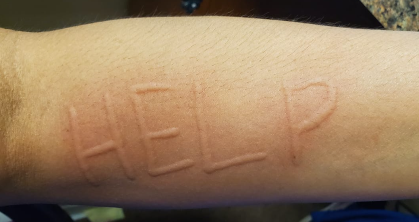 The word HELP raised in red welts on a forearm