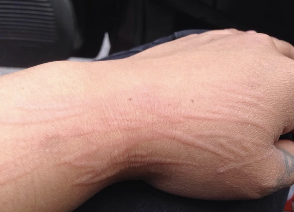 Close-up of raised red welts across the back of a hand