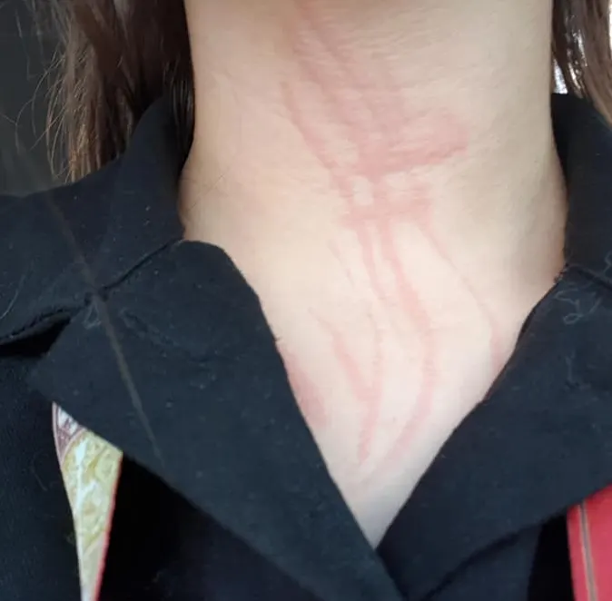 Neck with raised red streaks following a light scratch
