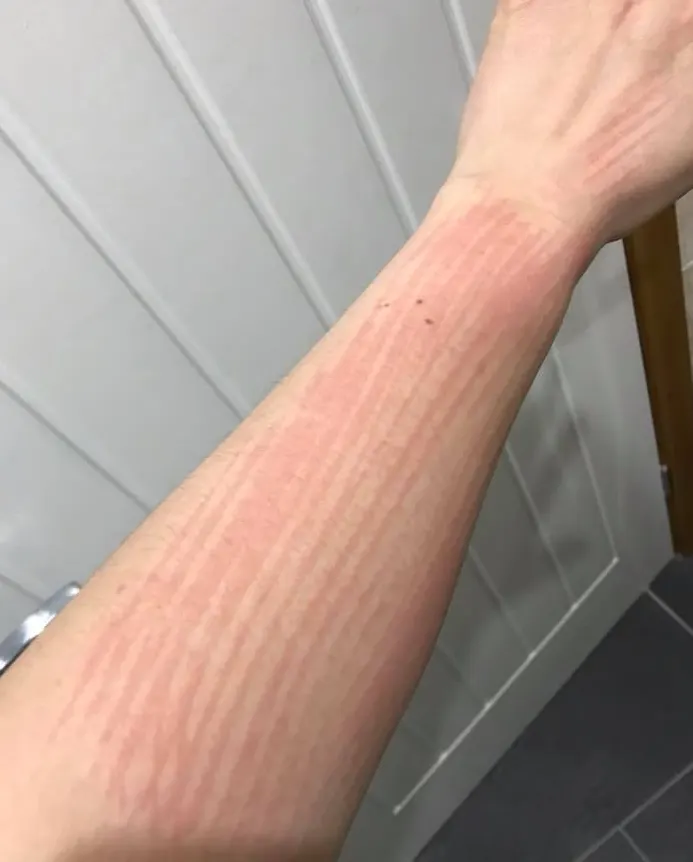Raised dermatographia welts striping a forearm after scratching