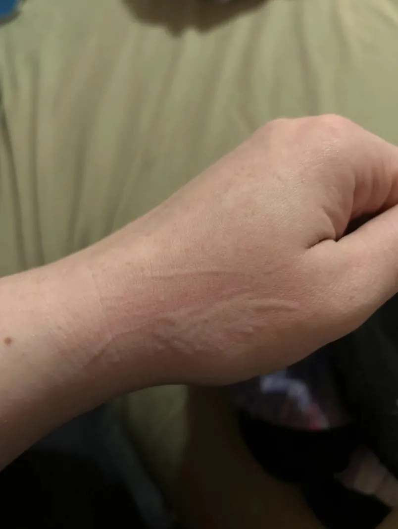 Faint raised lines on the inner wrist after light scratching