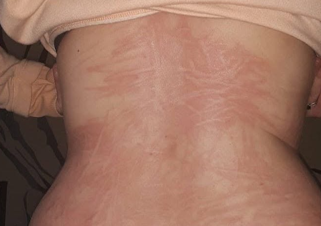 Lower back with extensive raised red welts
