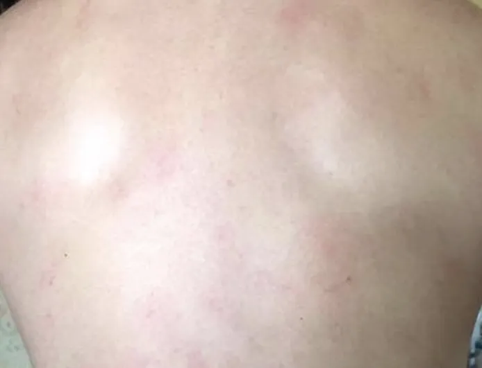 Close detail of raised red hives on the back