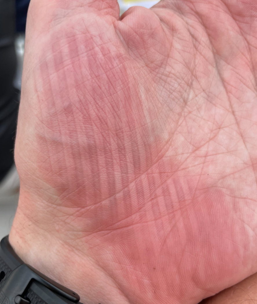 Palm showing a ridged red imprint left by gripping a textured object