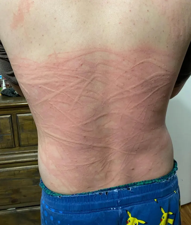 Back with broad raised red welts during an active flare