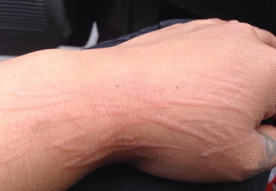 Back of a hand with raised welt lines