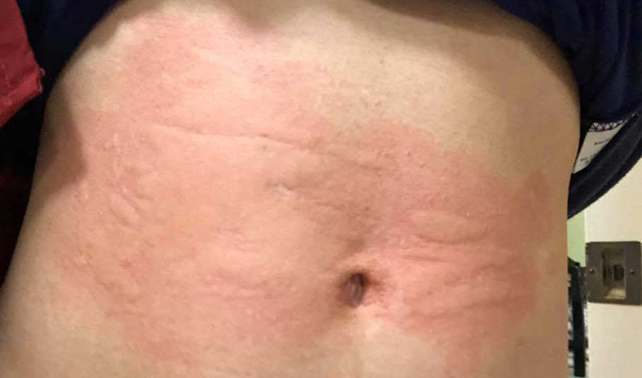Abdomen with welts along the waistband line