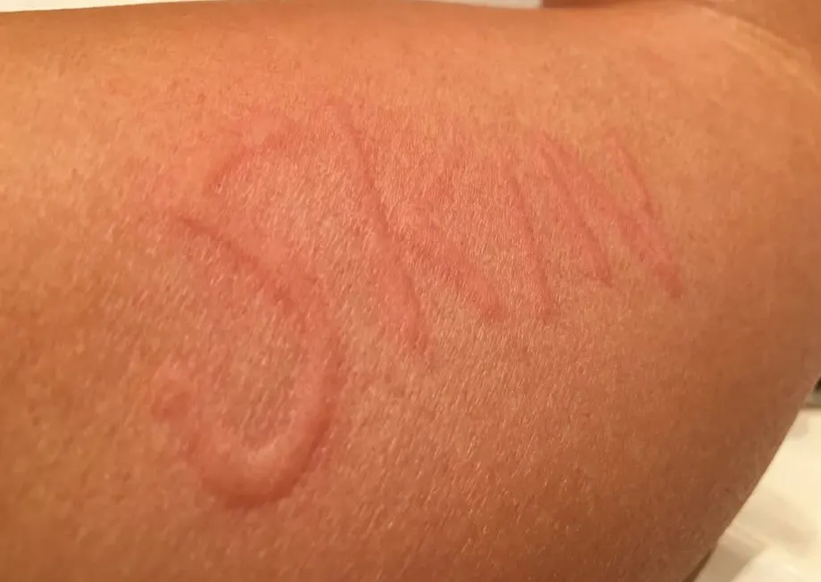Close-up of an inner wrist showing a raised red dermatographia welt drawn by a fingernail