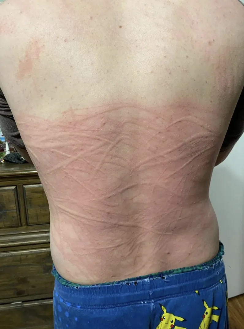 Criss-crossed raised scratch lines across a lower back at night