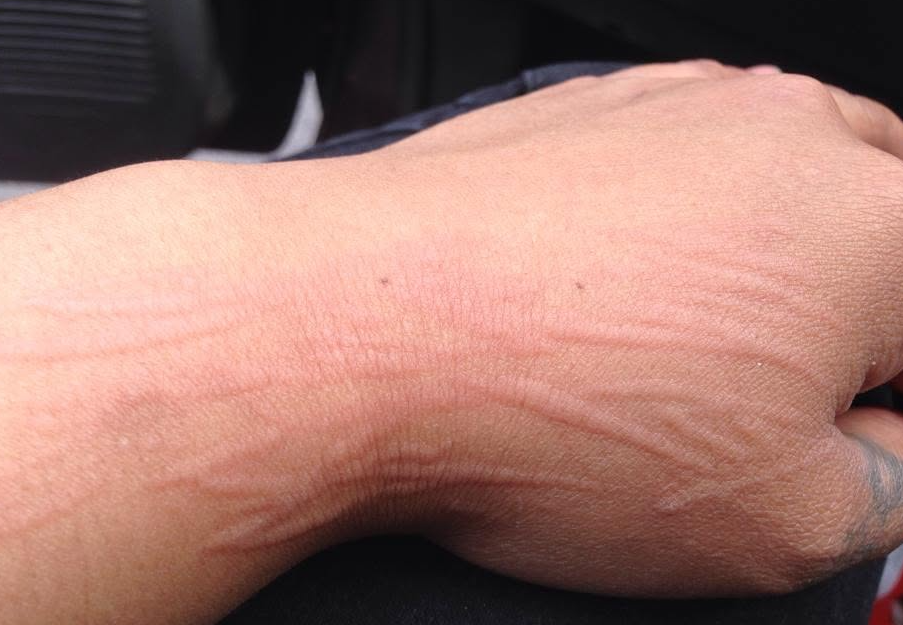 Back of a hand with raised welt lines