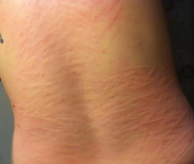 Side of the torso with pale criss-crossing lines as a flare settles