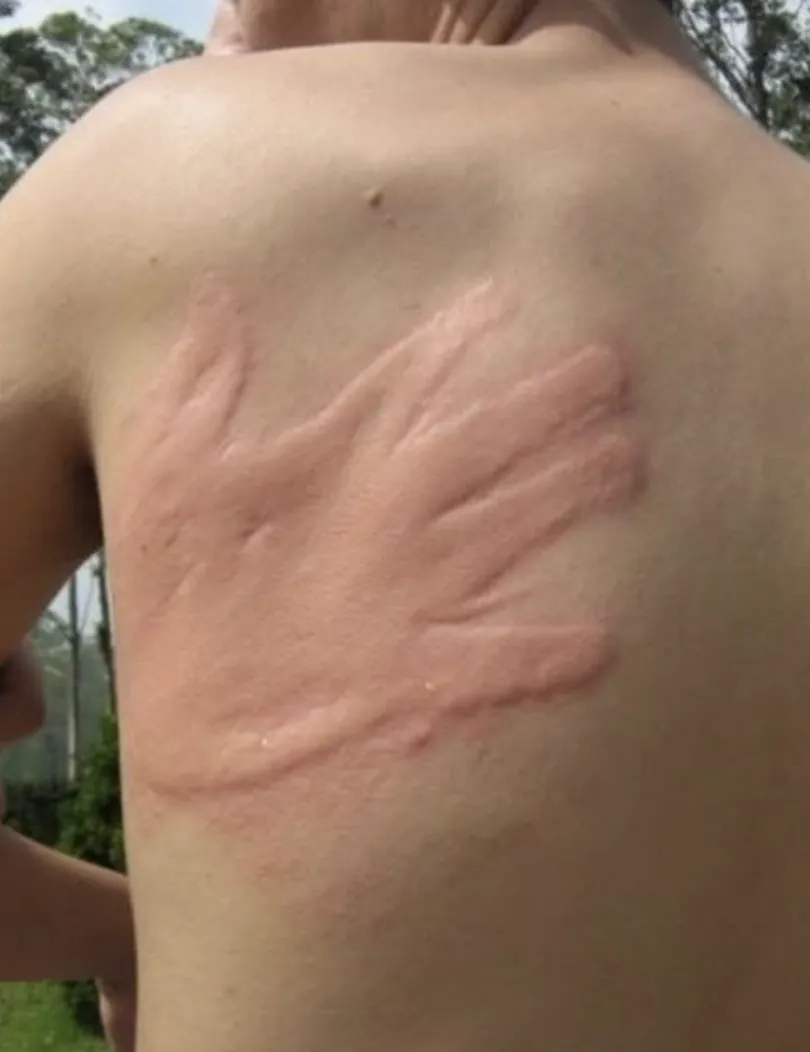 A raised handprint across an upper back where a hand pressed against the skin