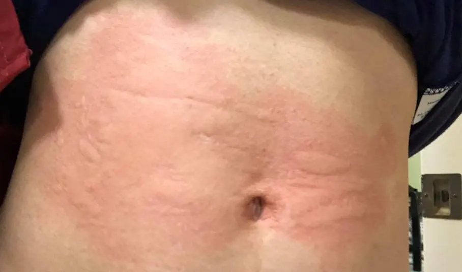 Abdomen with welts along the waistband line