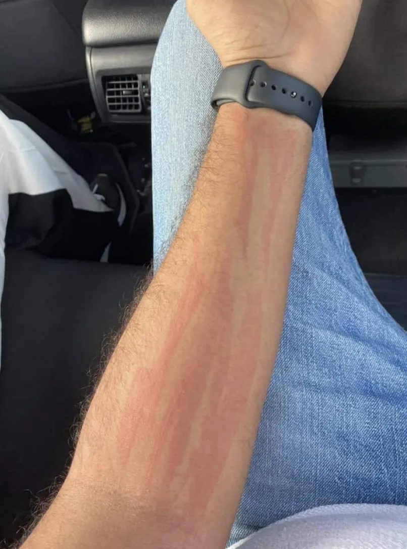 Pale and red stripes down a forearm after light pressure
