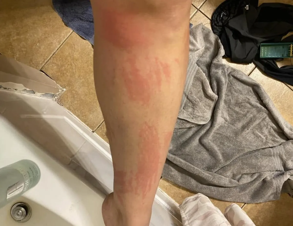 Raised welts and pale streaks across a lower leg
