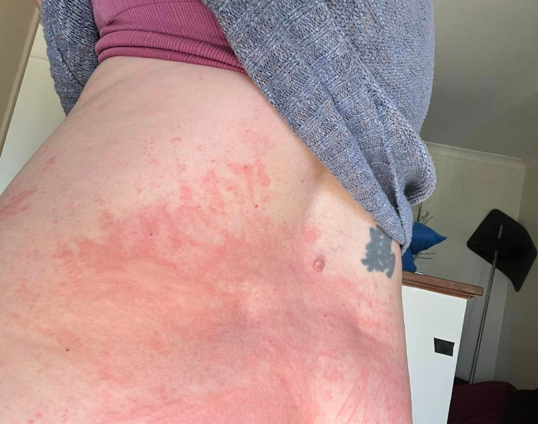 Widespread red patches along the side of a hip and torso