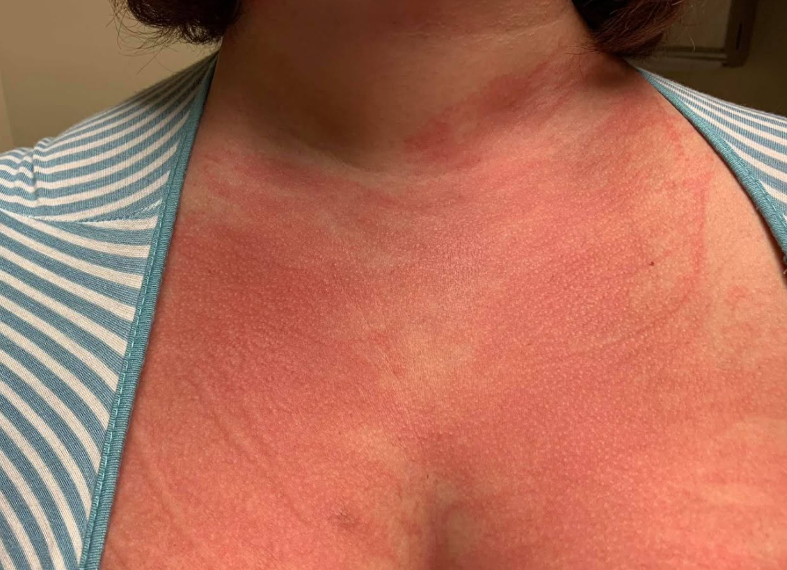Intensely red flushed neck with raised welt lines after scratching