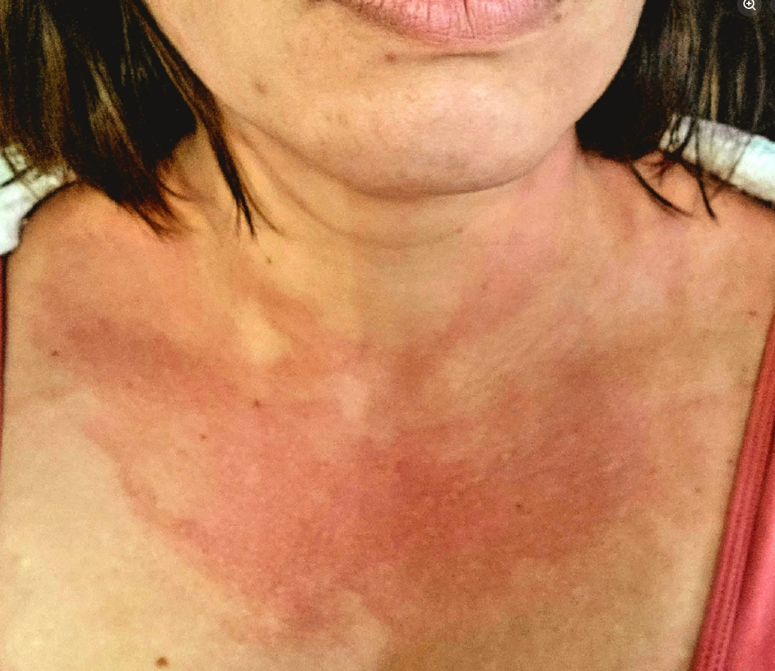 Neck and chest with blotchy raised patches