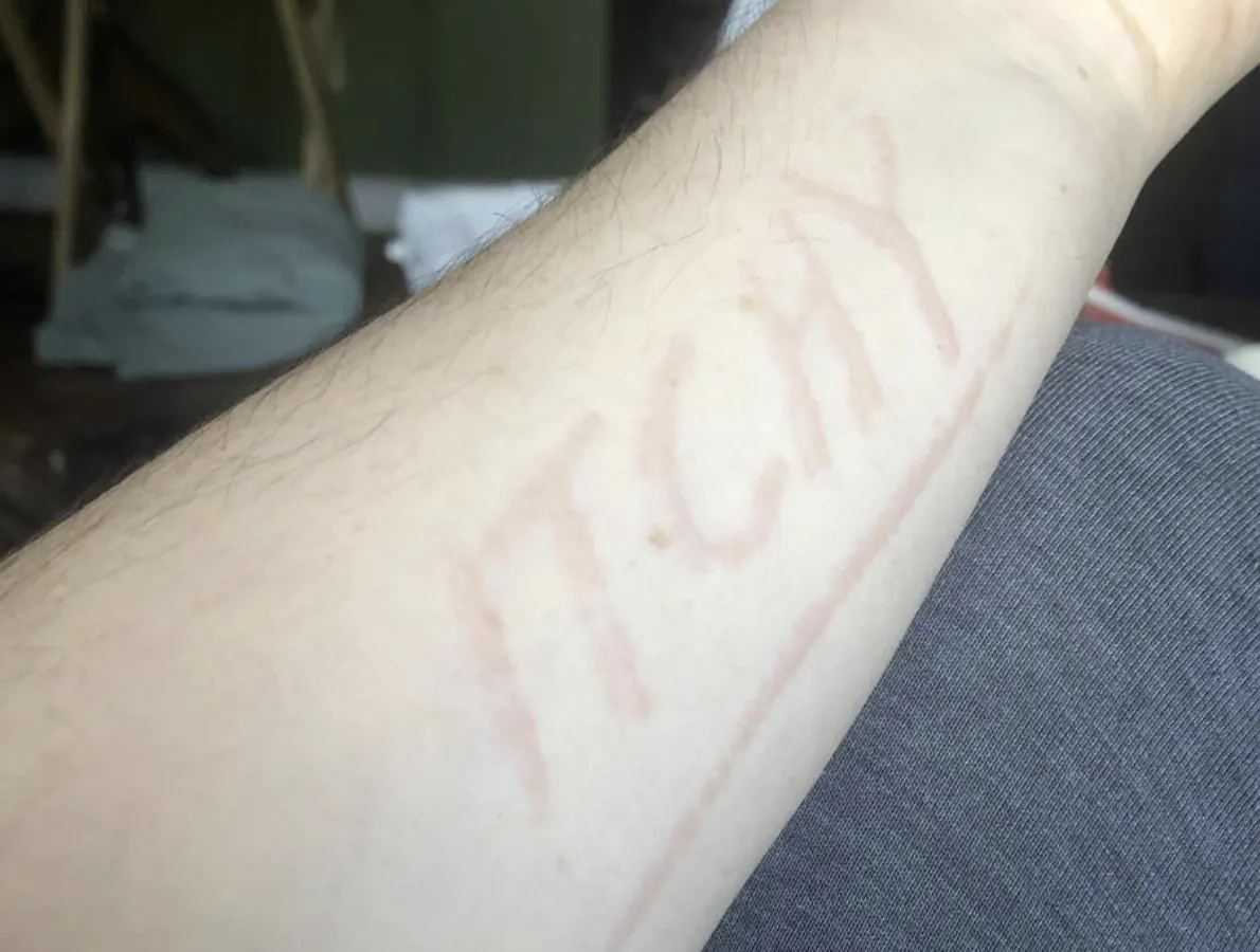 The word ITCHY raised in pale welts on a forearm after being traced with a fingernail