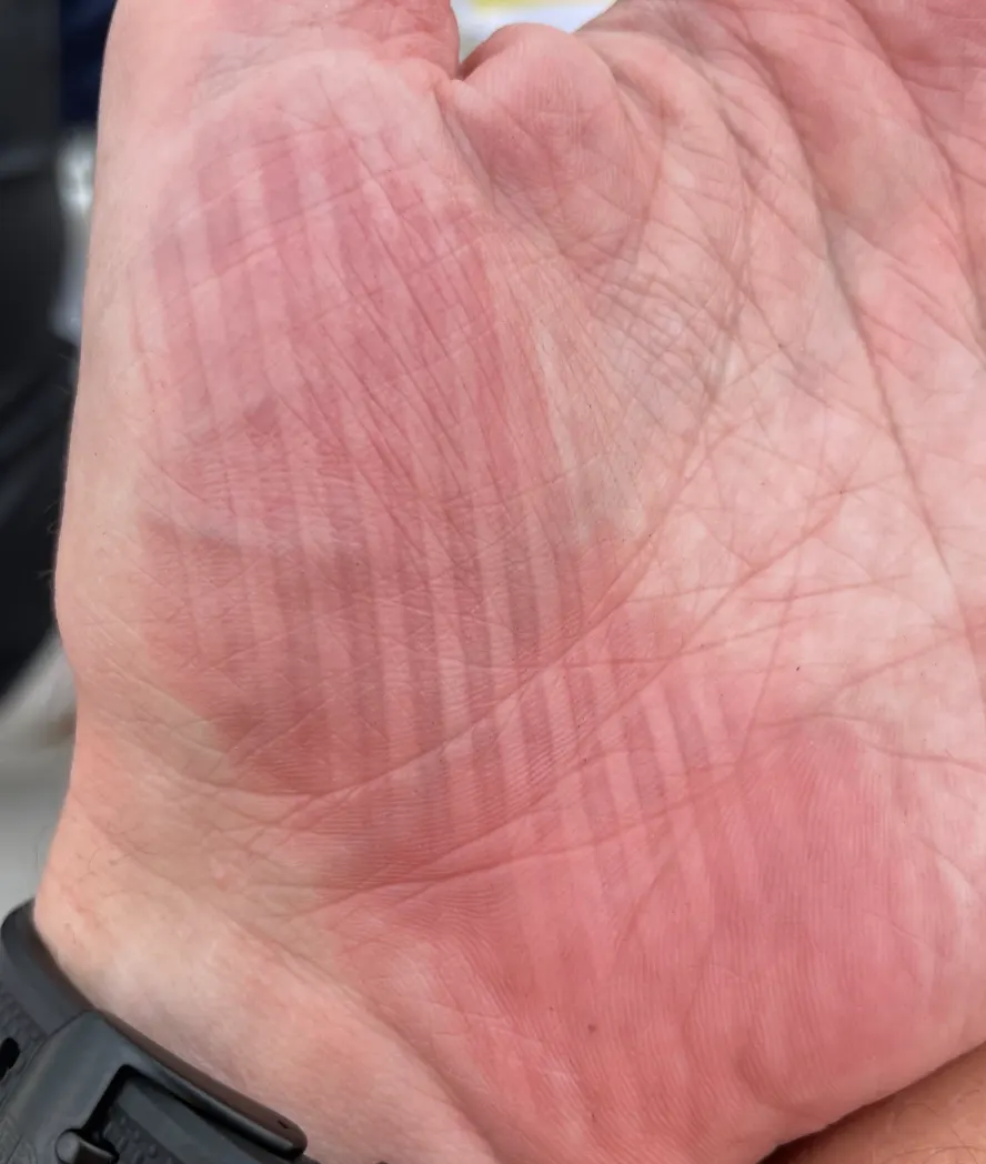 Palm showing a ridged red imprint left by gripping a textured object
