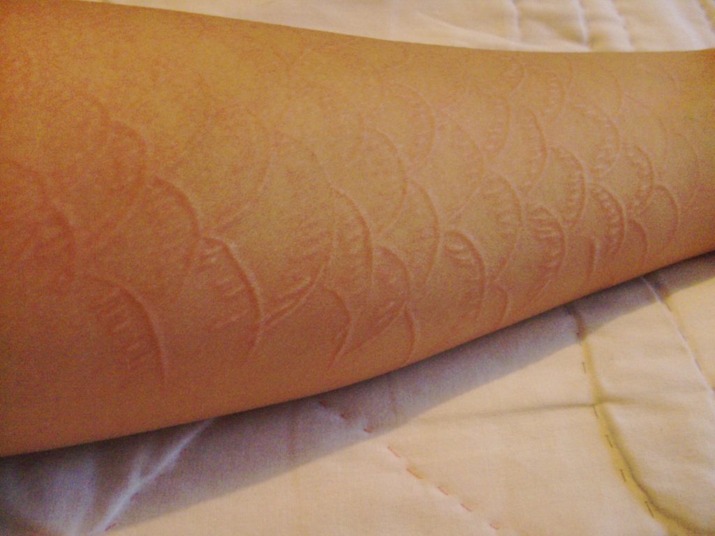 common symptoms of dermatographia urticaria