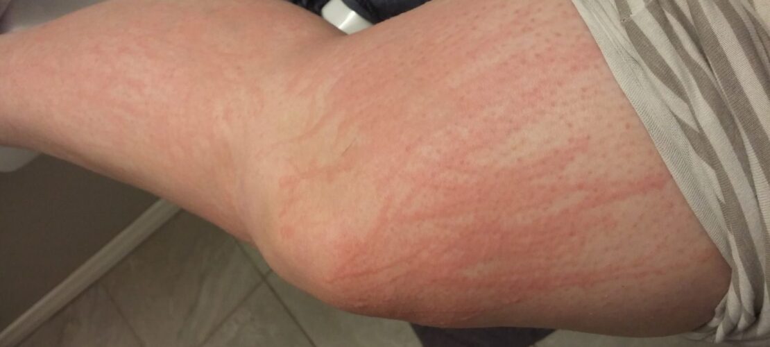 common symptoms of dermatographia on the leg