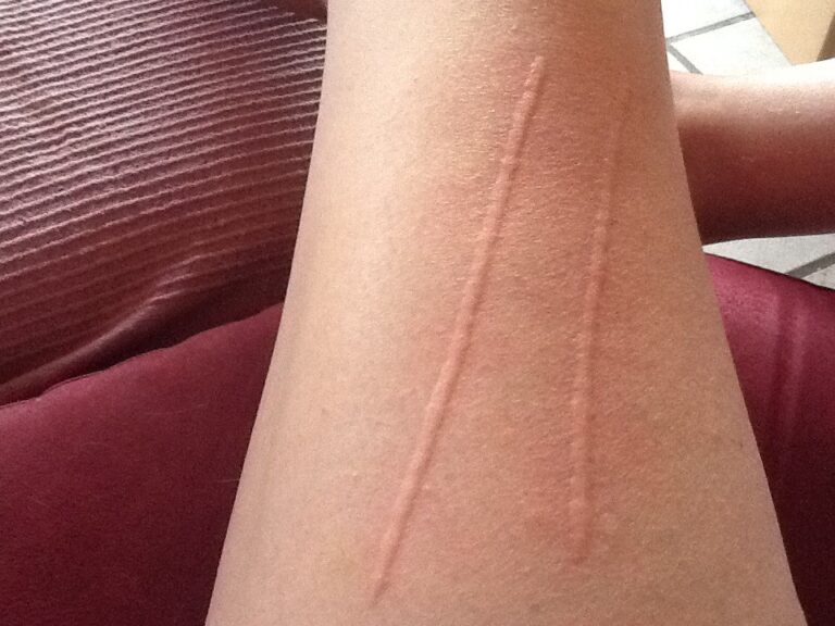 cure for dermatographia