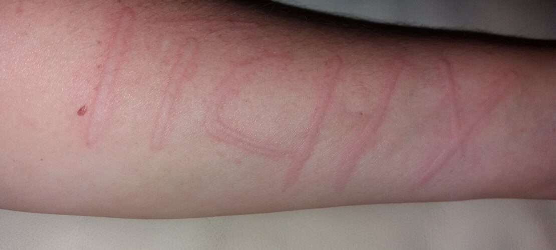 immune system issues caused by dermatographia