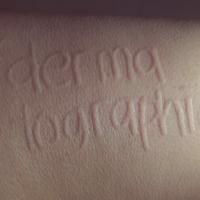 real stories from people with dermatographia