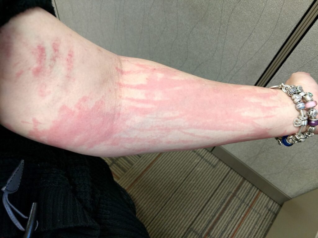 itchy skin on the arm symptoms