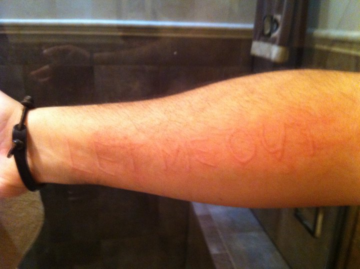 dermatographia skin writing words on someone's arm