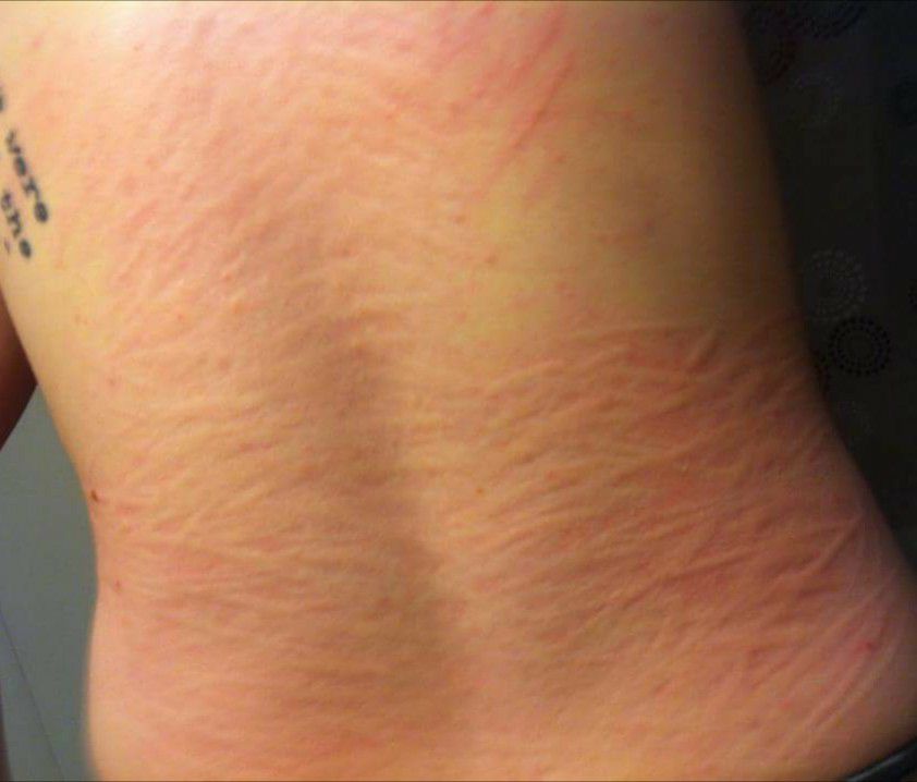 dermatographia on the lower back