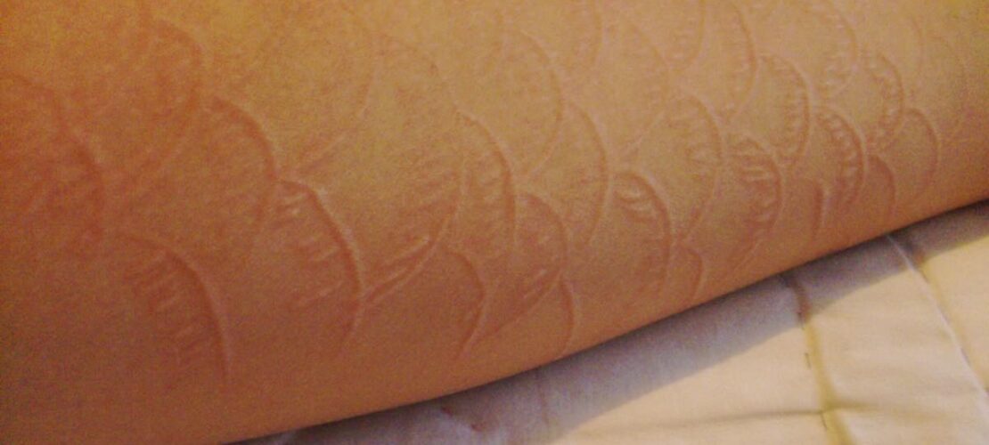 creative pictures of dermatographia skin writing