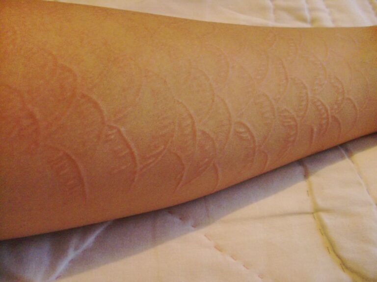 creative pictures of dermatographia skin writing
