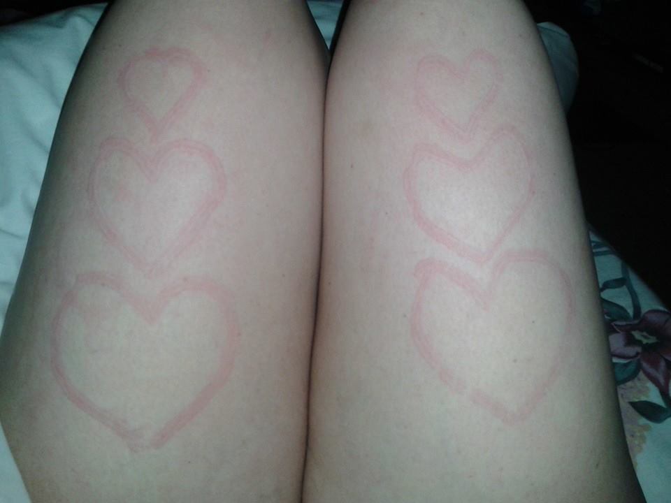 dermatographia hearts on a woman's legs