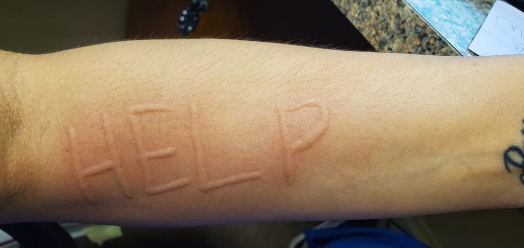 "help" writting on a man's arm with dermatographia