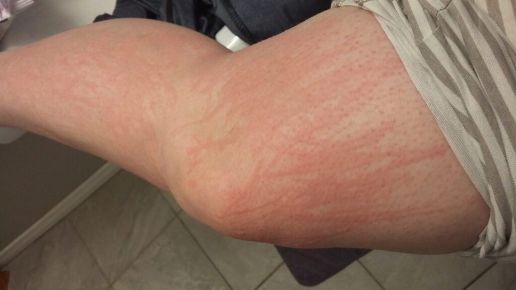 dermatographia itches on a man's leg