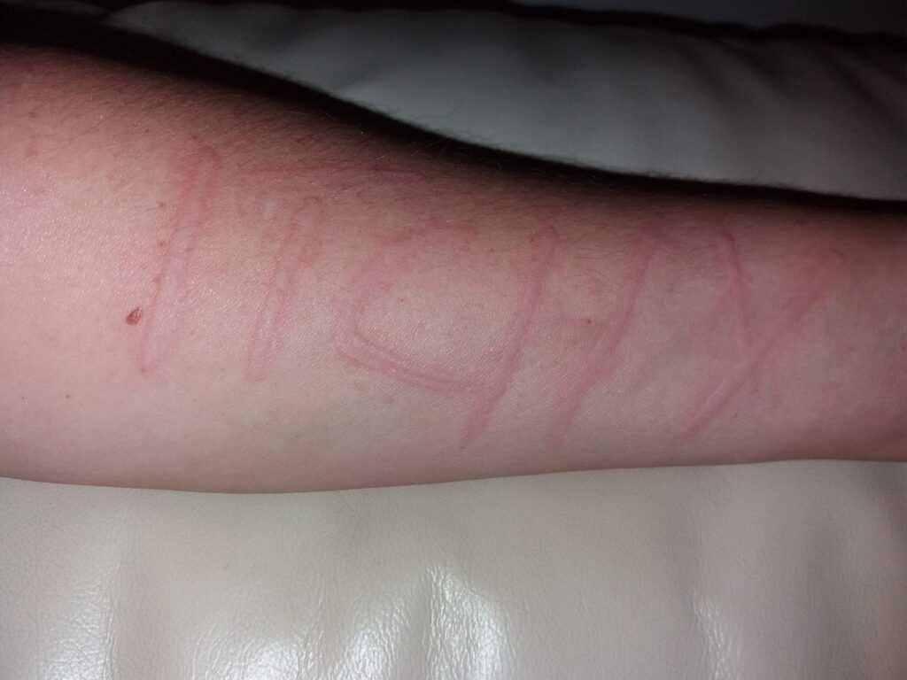 dermatographia "itchy" word written on someone's arm