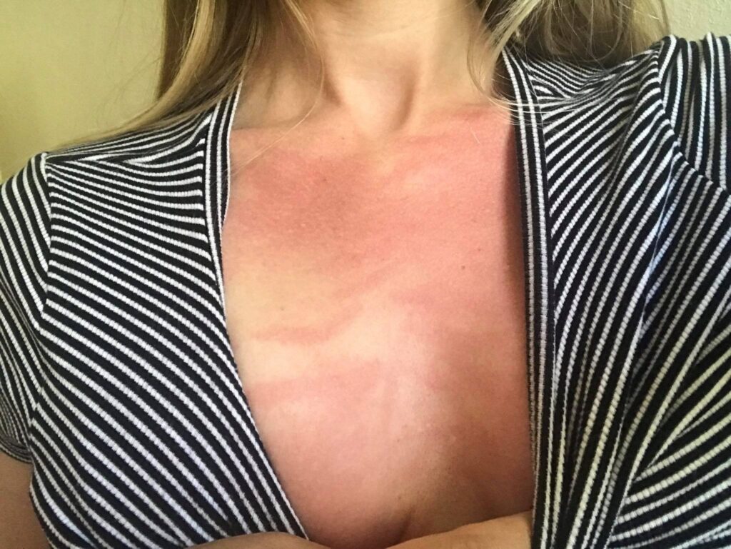 dermatographia on the chest of a woman