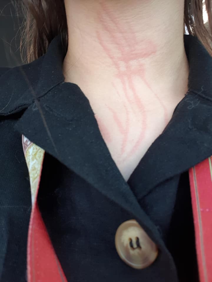 dermatographia red lines on a woman's neck