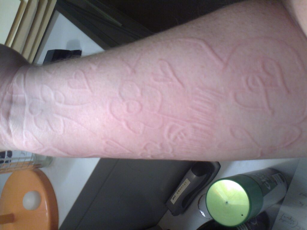 dermatographia skin writing on the forearm