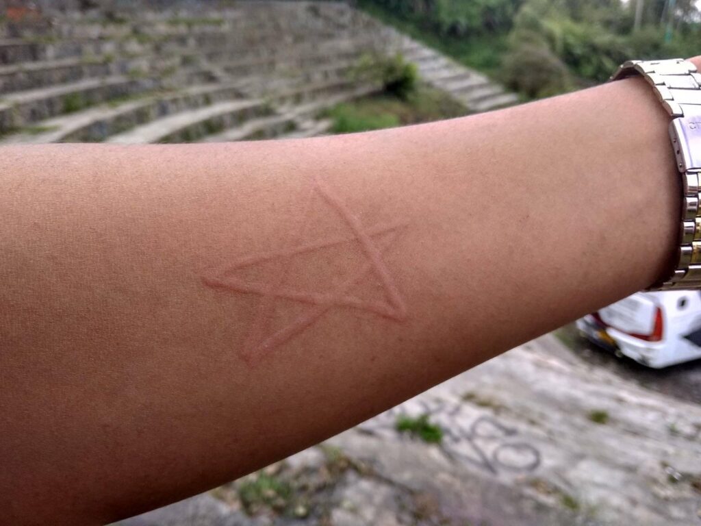 dermatographia skin writing on a forearm of a man