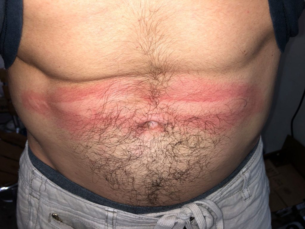 dermatographia red lines on a man's stomach