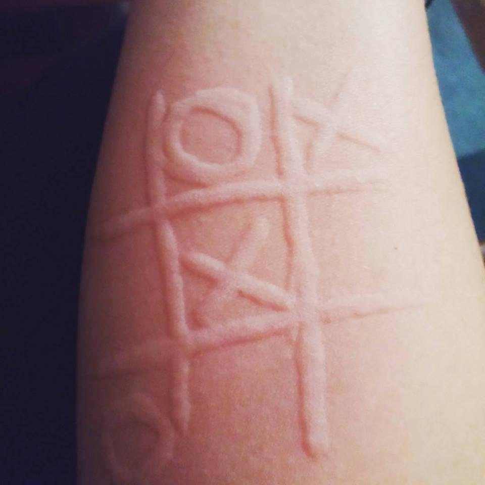 tic tac toe dermatographia on someone's skin