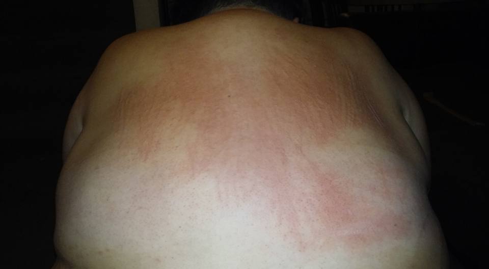 dermatographia red marks on the upper back