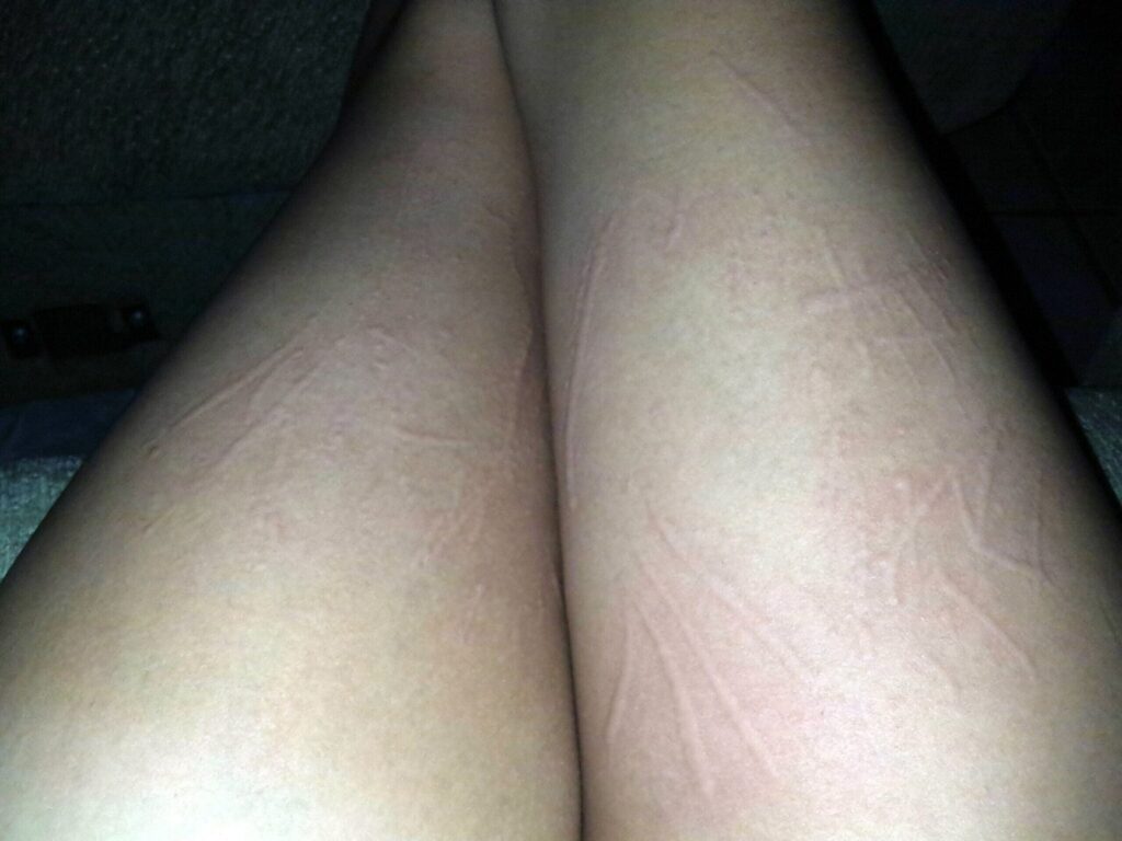 dermatographia red lines and welts on a woman's legs